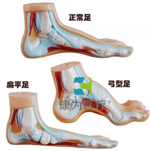 “康為醫(yī)療”正常足、扁平足、弓型足模型