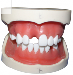種植牙模型（含上、下頜）